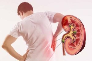 Symptoms of Kidney Stones