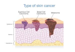 skin cancer 