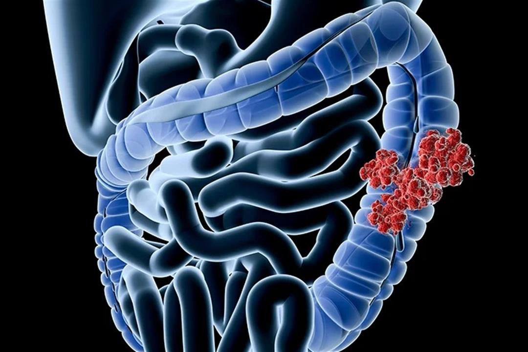 Adenocarcinoma