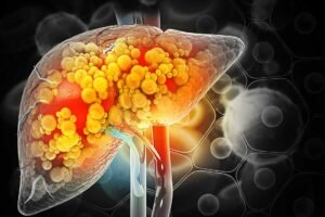 Liver Cancer