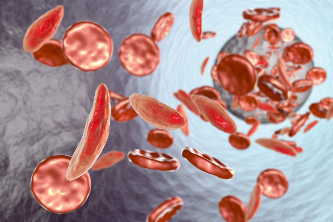 Sickle Cell Disease