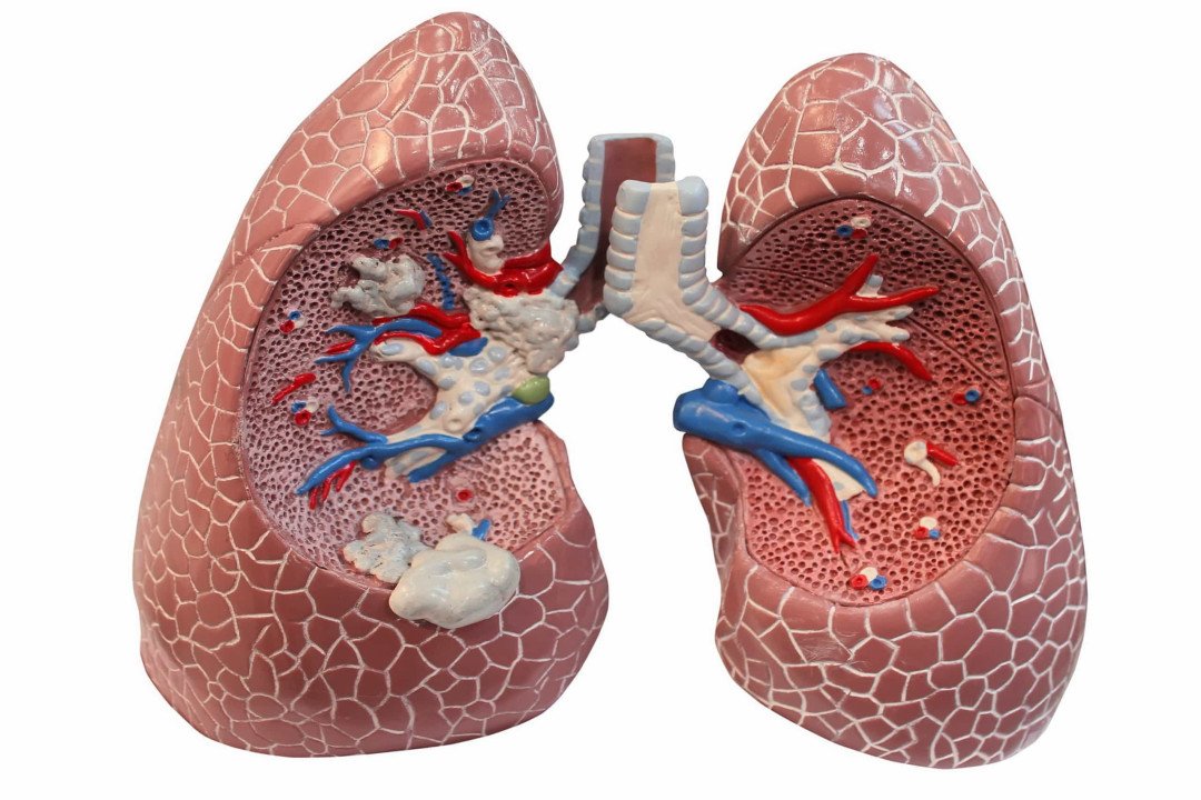 Small Cell Lung Cancer (SCLC)